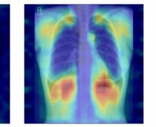 흉부 엑스레이만 찍어도 '골다공증' 알 수 있다…AI 개발한 서울대병원