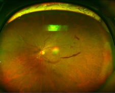 흐릿한 눈 앞, 나이 탓만 했다간...'조용한 실명' 다가온다