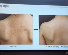 아토피피부염 치료 시작은 '보습'…WHO가 인정한 '황금레시피' 나왔다