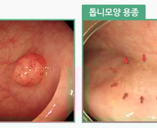 "나 대장 용종 뗐대" 암 불안감에 덜덜...의사는 "오히려 안심" 왜?