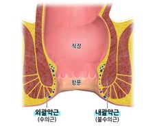 항문에 '이것' 넣었다가..."대장 뚫렸다" 40대남성 엽기행위 충격[한 장으로 보는 건강]