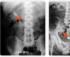 "맥주? 안 아프려고 먹지" 벌컥벌컥...'요로결석' 속설, 진짜일까[한 장으로 보는 건강]