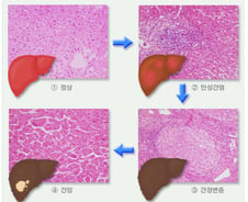 "간수치 정상이라 안심했는데"…올해부턴 '이것' 많으면 치료 권고