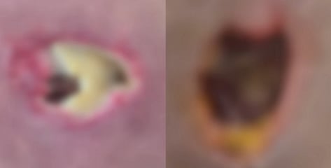 마사지받다 잠들자 "멋대로 불법시술"...피부 괴사→절제, 무슨 일?