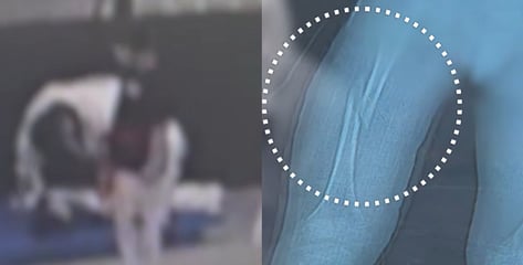 "몸부림 쳐도 강제 다리찢기" 7살 대퇴골 골절...태권도 관장 "집중 안해서"