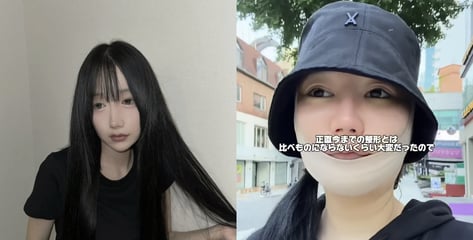 "한국서 수술 받고 입·턱 마비 상태"…日인플루언서 부작용 호소