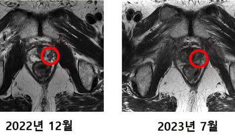 두경부암·육종·재발성 직장암까지…연세암병원 "중입자치료 확대" 썸네일