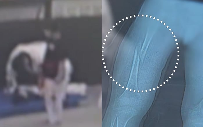 "몸부림 쳐도 강제 다리찢기" 7살 대퇴골 골절...태권도 관장 "집중 안해서"