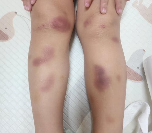 "아기와 신나게 놀았는데" 멍 들어서 학대 신고→강제분리 된 사연